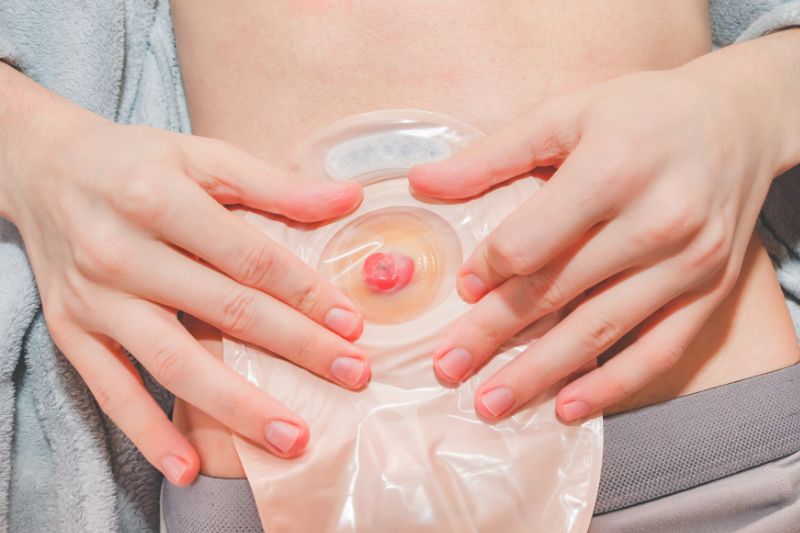 Stoma Care