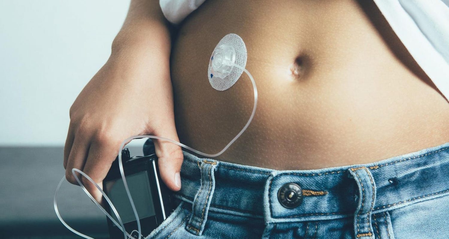 NHS in England to offer Artificial Pancreas to help manage Type 1 Diabetes